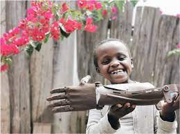 Elix Polymers and Ayúdame3D join forces to produce solidarity prostheses using recovered ABS